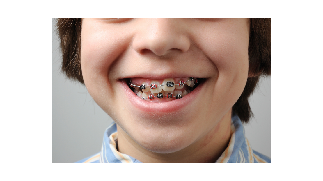 Kid smiling in Braces